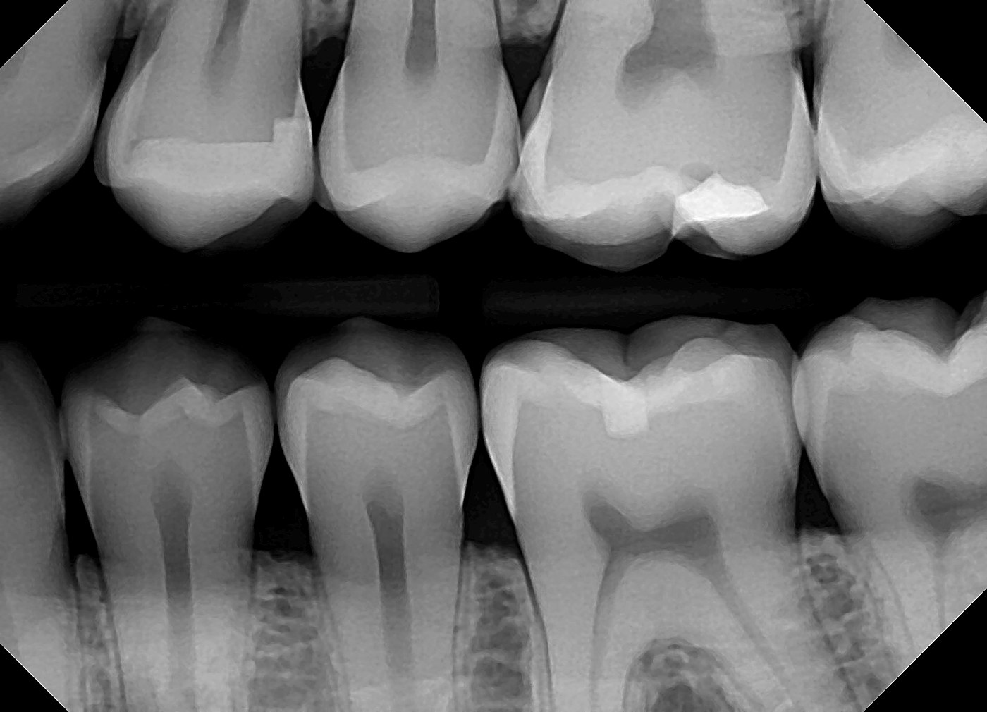 Radiografía bitewing real con dos tapaduras marcadas
