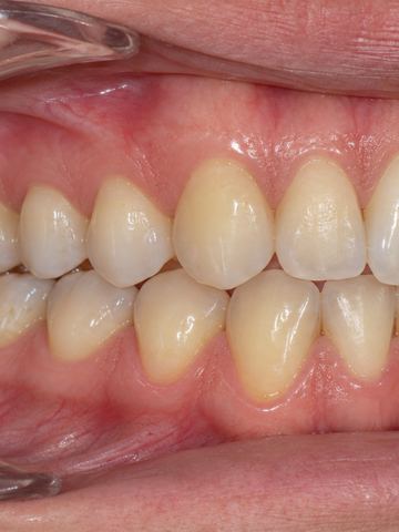 Foto intraoral lateral derecha de ejemplo