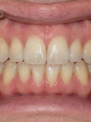 Foto intraoral frontal de ejemplo
