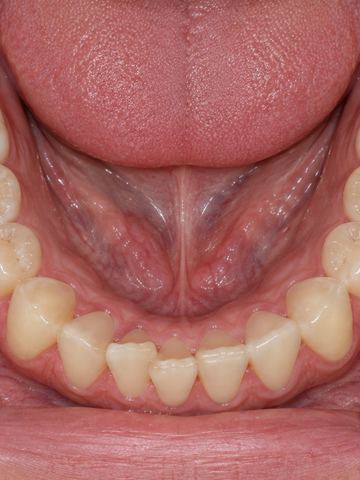 Foto intraoral oclusal inferior de ejemplo