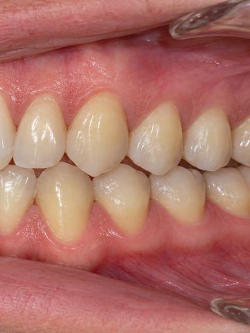 Foto intraoral lateral izquierda de ejemplo