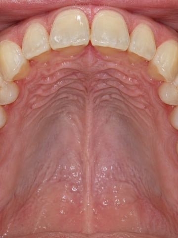 Foto intraoral oclusal superior de ejemplo